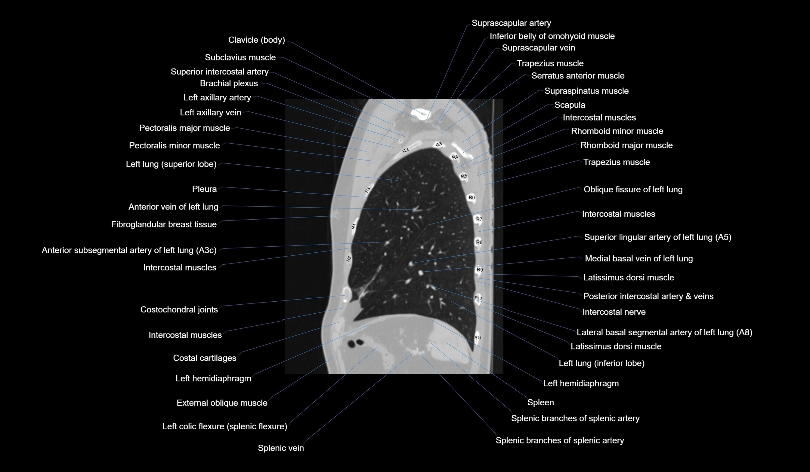 CT chest (thorax) lung window labelled sagittal cross sectional anatomy radiology image-00112.webp